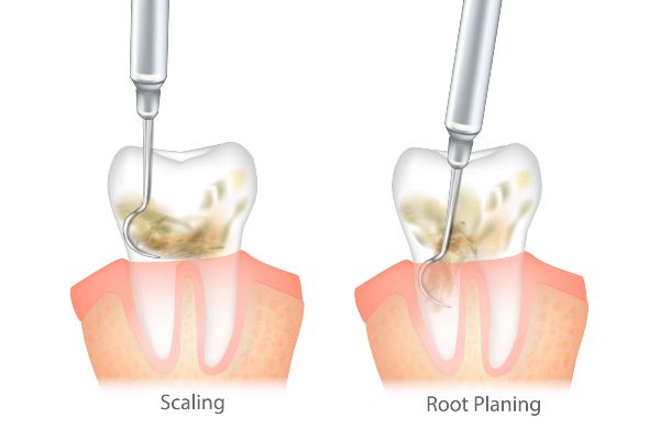 Dental Scaling Root Planing in South Edmonton AB